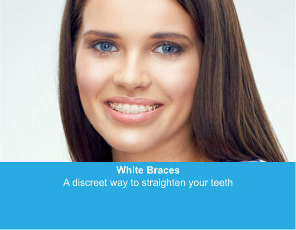 White Braces A discreet way to straighten your teeth