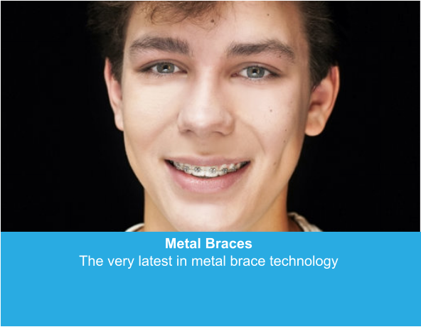 Metal Braces The very latest in metal brace technology