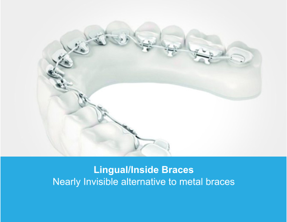 Lingual/Inside Braces Nearly Invisible alternative to metal braces