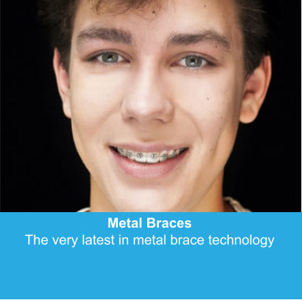Metal Braces The very latest in metal brace technology