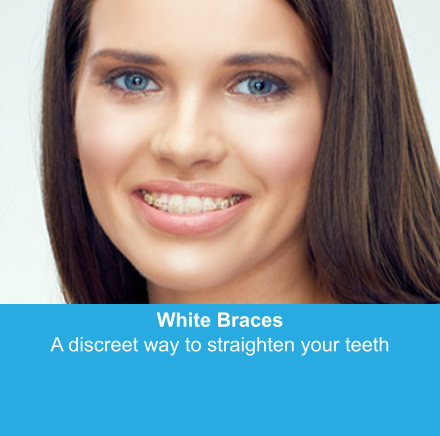 White Braces A discreet way to straighten your teeth