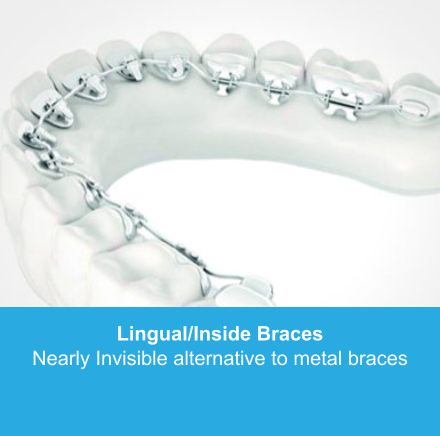 Lingual/Inside Braces Nearly Invisible alternative to metal braces